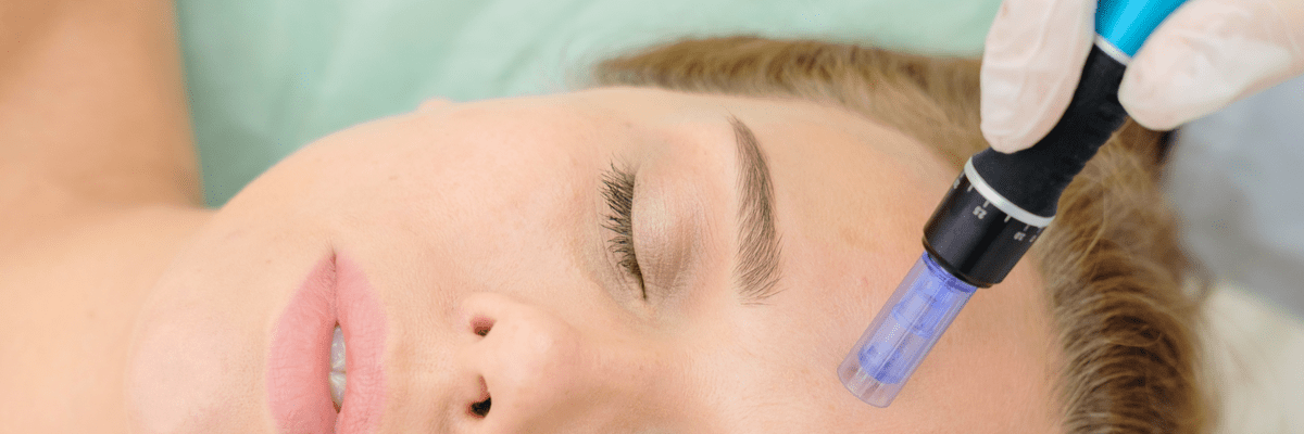 microneedling viso trattamento