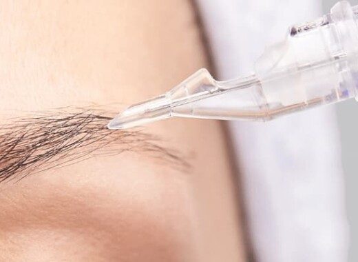 Allergie microblading